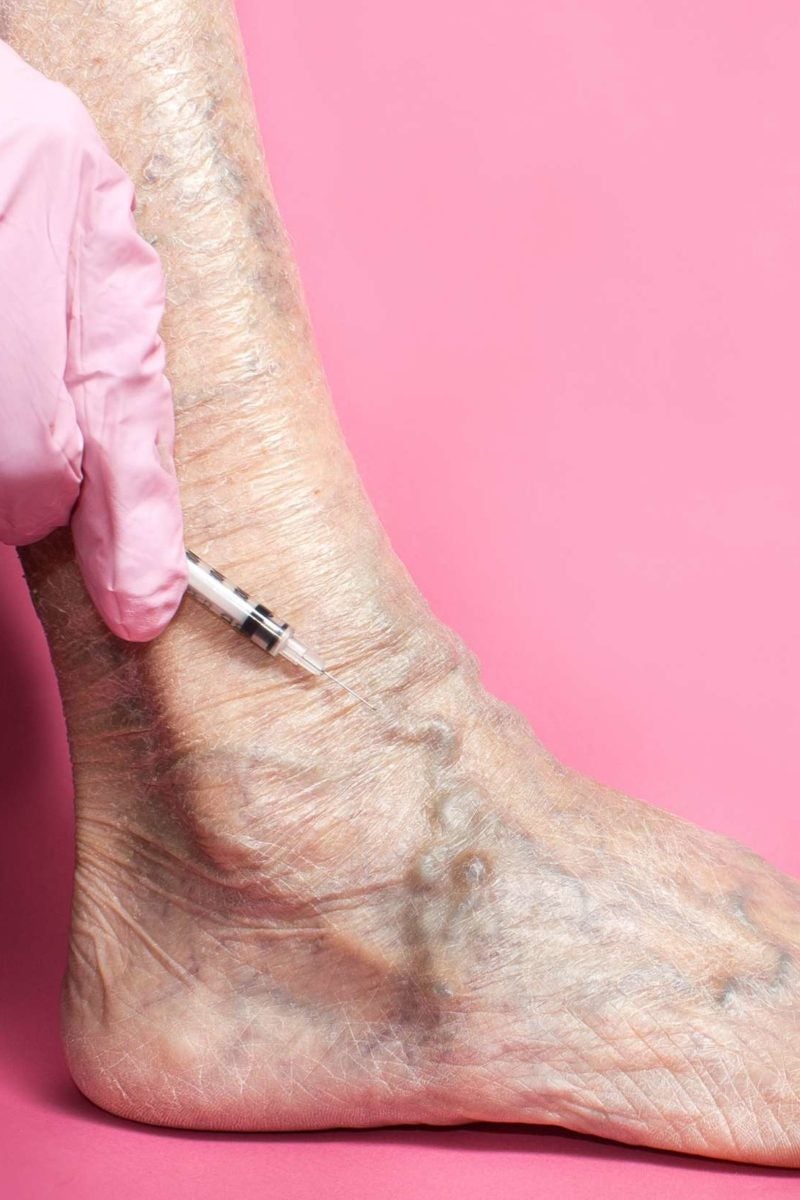 Sclerotherapy Uses Side Effects And Recovery