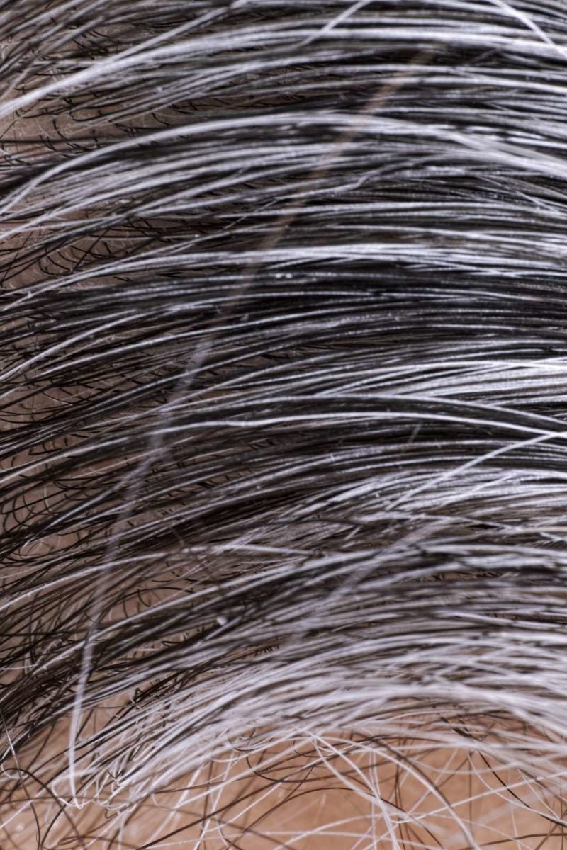 White hair Causes and ways to prevent it