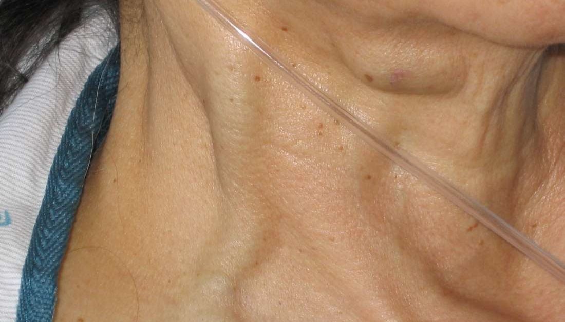 What Does Distended Neck Veins Mean