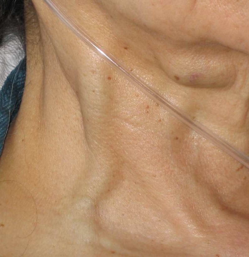 Are Bulging Neck Veins Dangerous