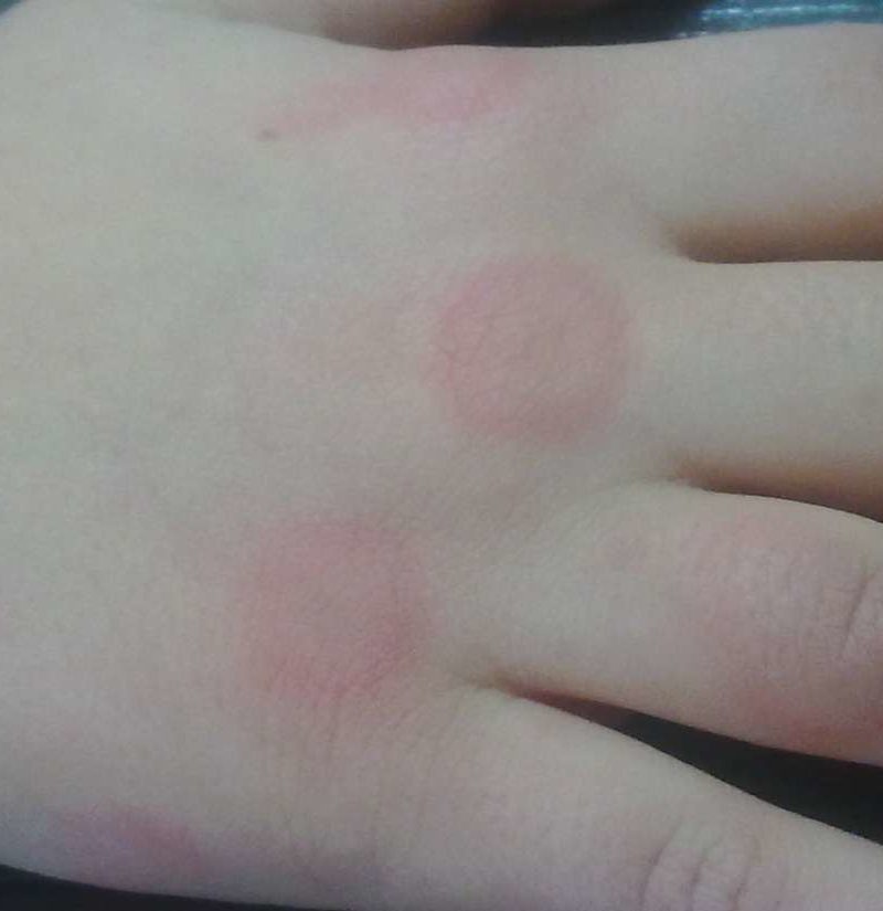 Spider Bites On Kids Fingers