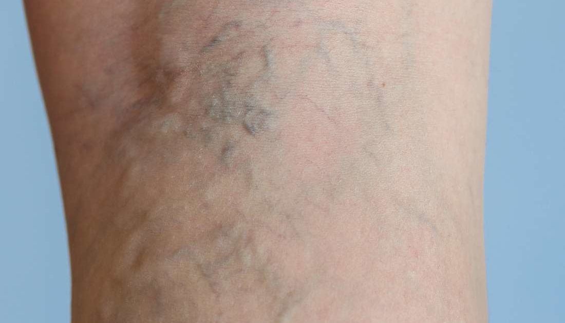 Painful Varicose Veinsspider Veins Varices On A Severely Affected