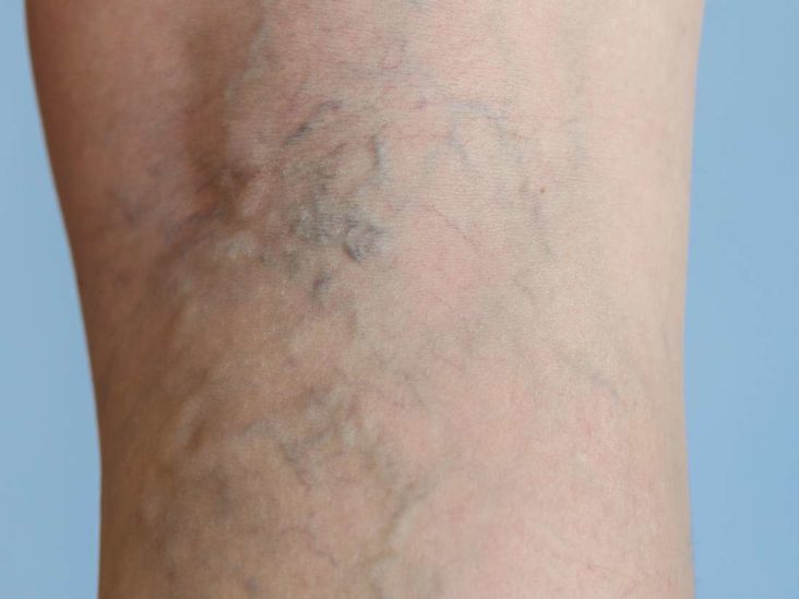 Can You Tattoo Over Varicose Veins  Stories and Ink