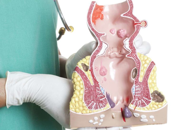 internal hemorrhoid swelling