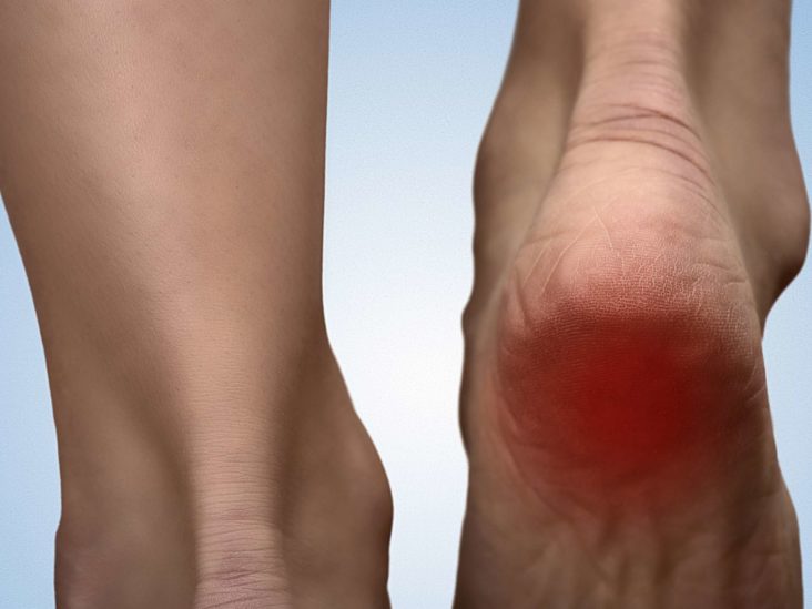 what causes sore heels