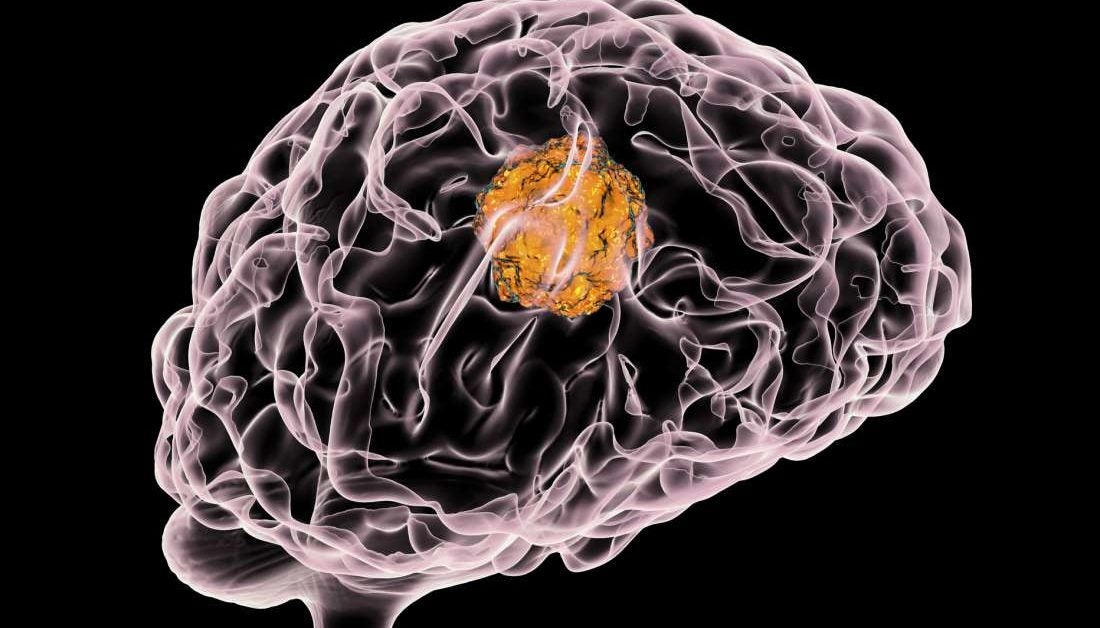 Electric field therapy boosts survival from deadly brain tumor