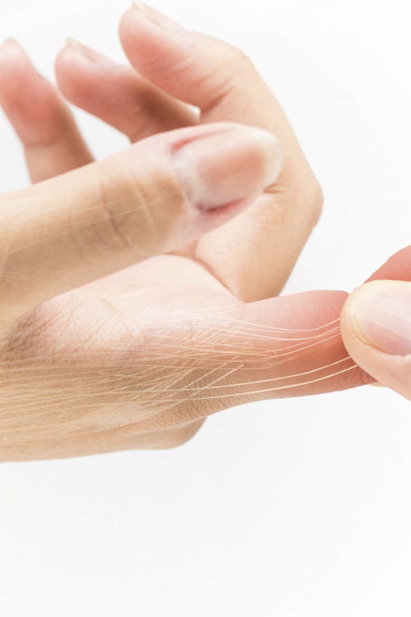 What Can A Doctor Do For A Sprained Finger