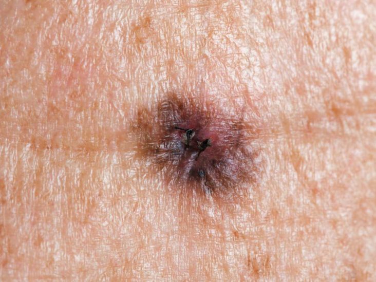 Subungual melanoma: Symptoms, risk factors, and treatment