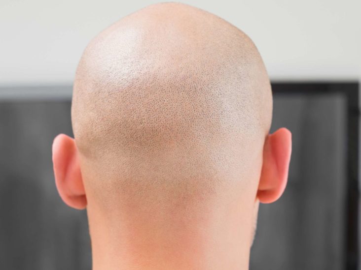 Receding hairline: stages, and causes