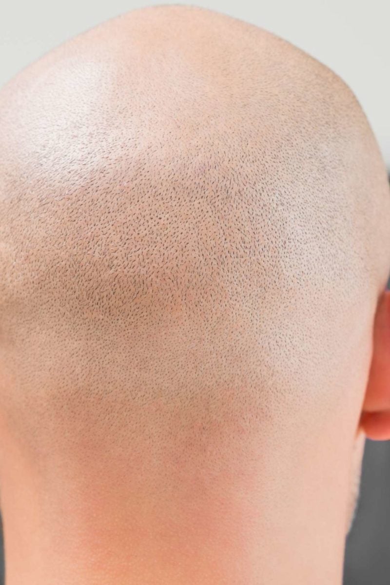 alopecia universalis causes