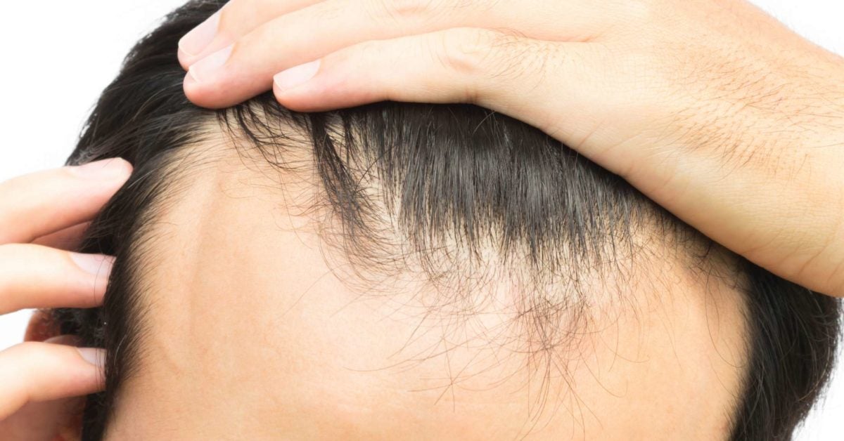 Hair Loss At The Temples Natural Remedies To Treat Hair Thinning