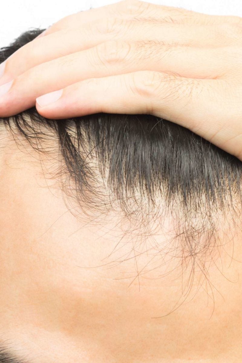 Receding Hairline Treatment Stages And Causes