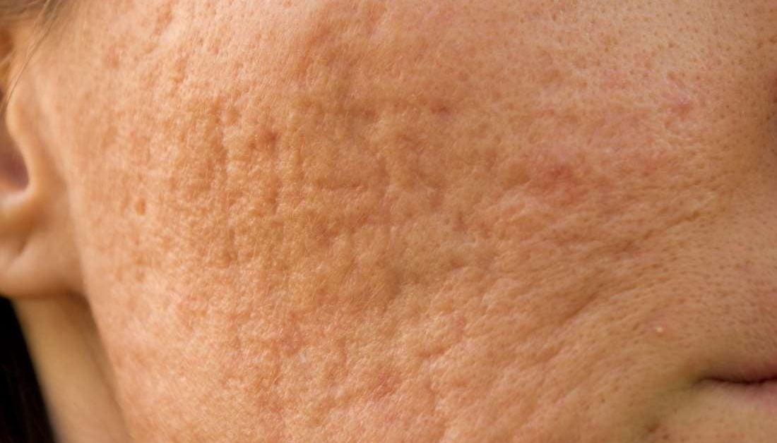 Pockmarks: Definition, causes, and treatment