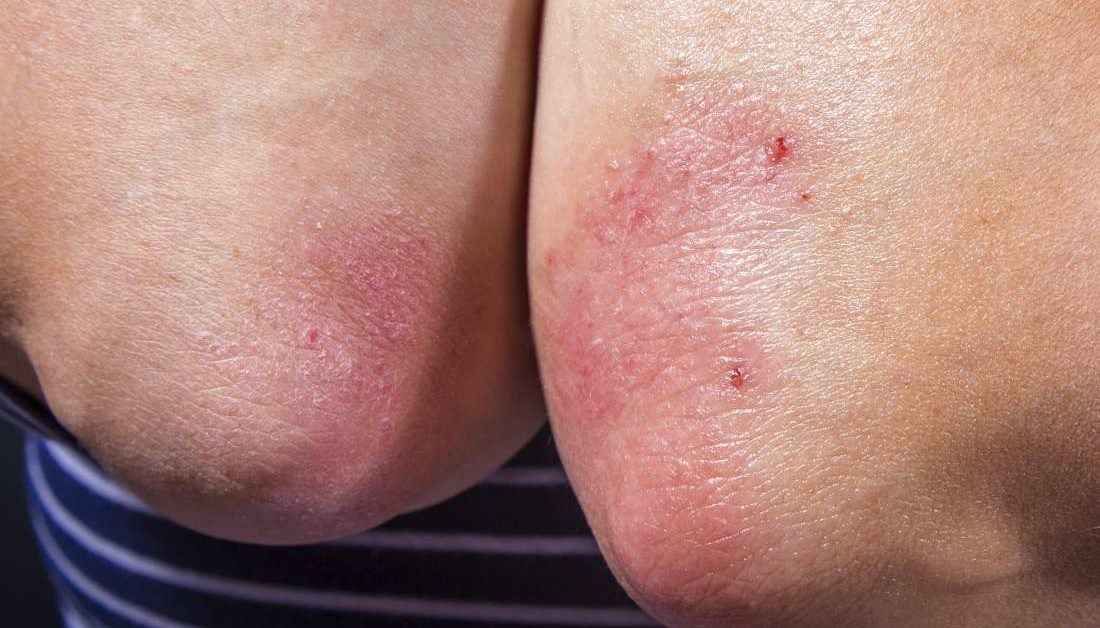 does psoriasis go away on its own