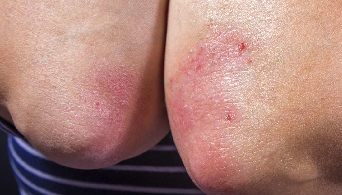 can psoriasis be transmitted