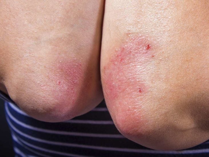 Plakk Psoriasis differenciáldiagnózis | Sanidex Magyarországon