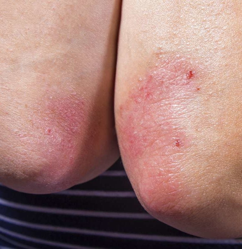 psoriasis healing process)