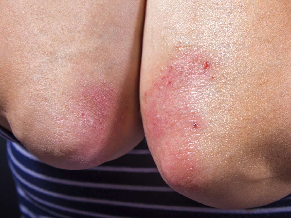 is psoriasis hereditary from grandparents