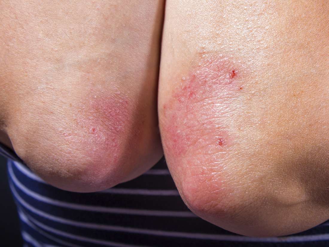 Típus kiütés psoriasis