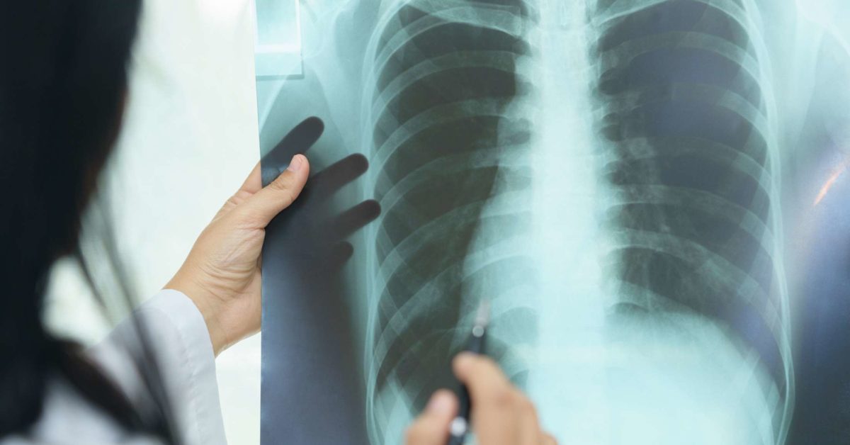 Interstitial lung disease: Causes, outlook, and diagnosis