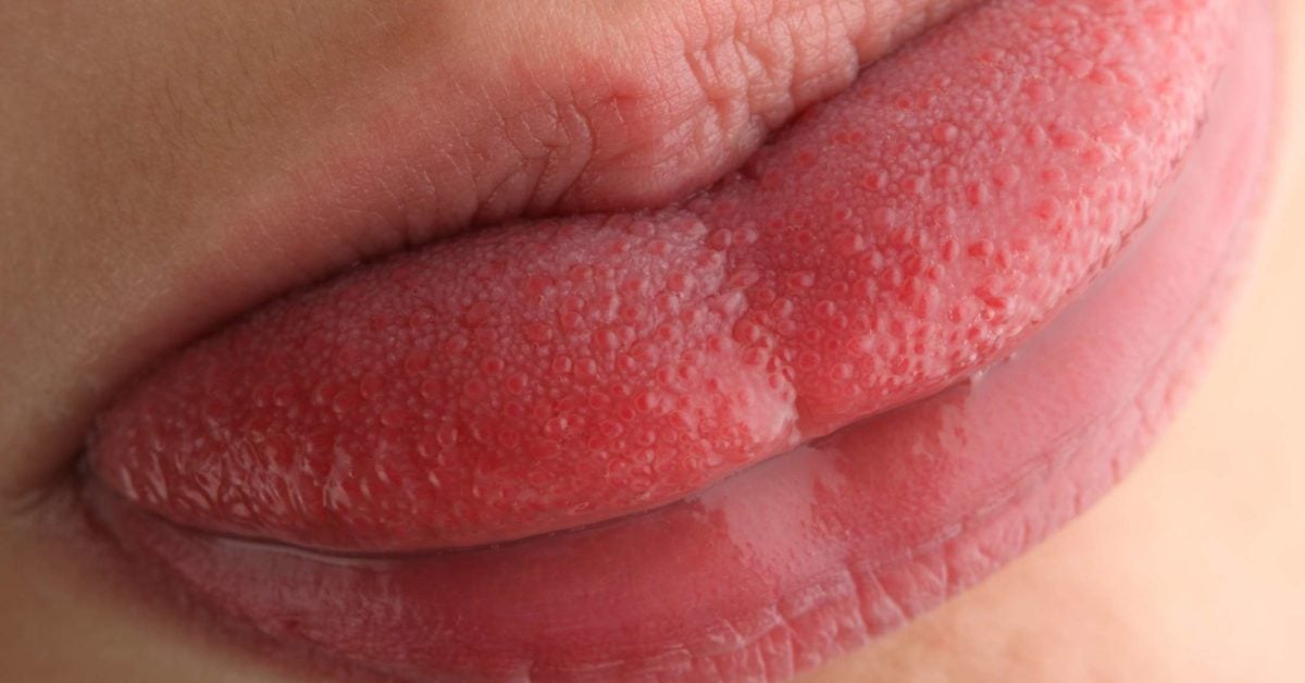 inflammation of tongue papillae plasturi kinoki