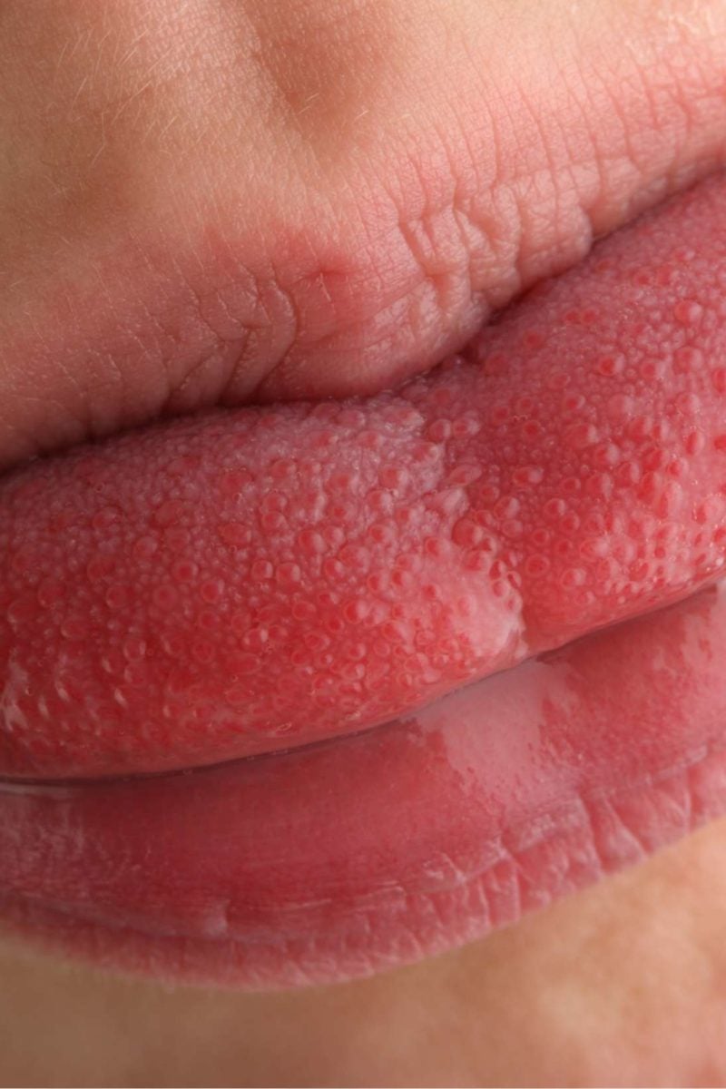 What Causes Swollen Taste Buds On Side Of Tongue