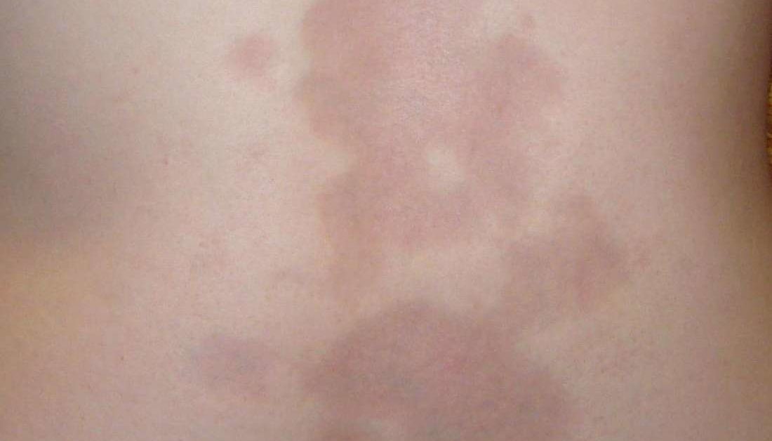 Morphea Symptoms Causes And Treatment