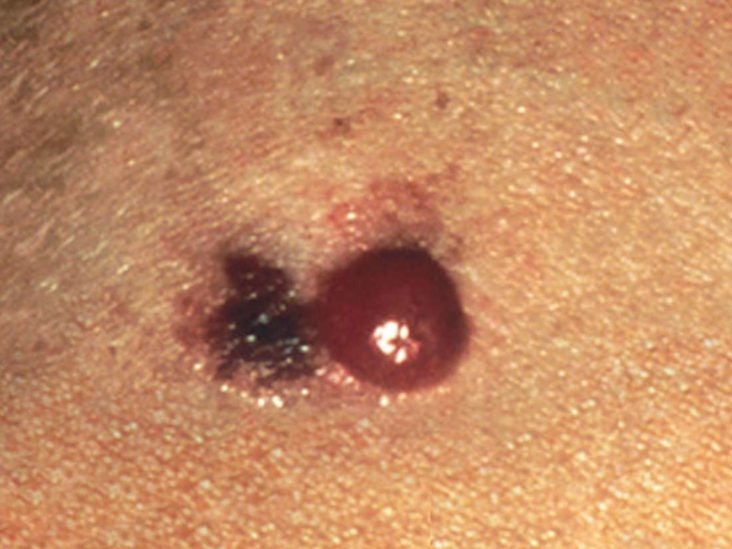 Merkel Cell Carcinoma Causes Symptoms And Treatment