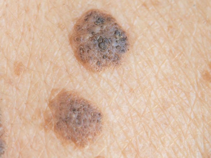 wart on face or skin cancer tratamentul ovocitelor și paraziților