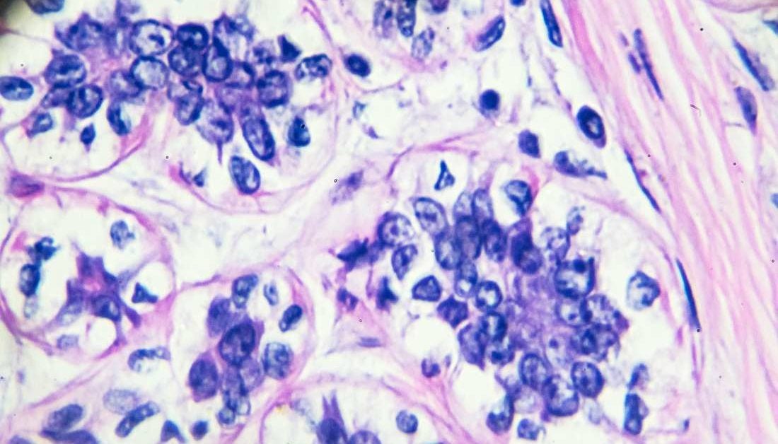 Breast cancer: Protein that drives metastasis uncovered