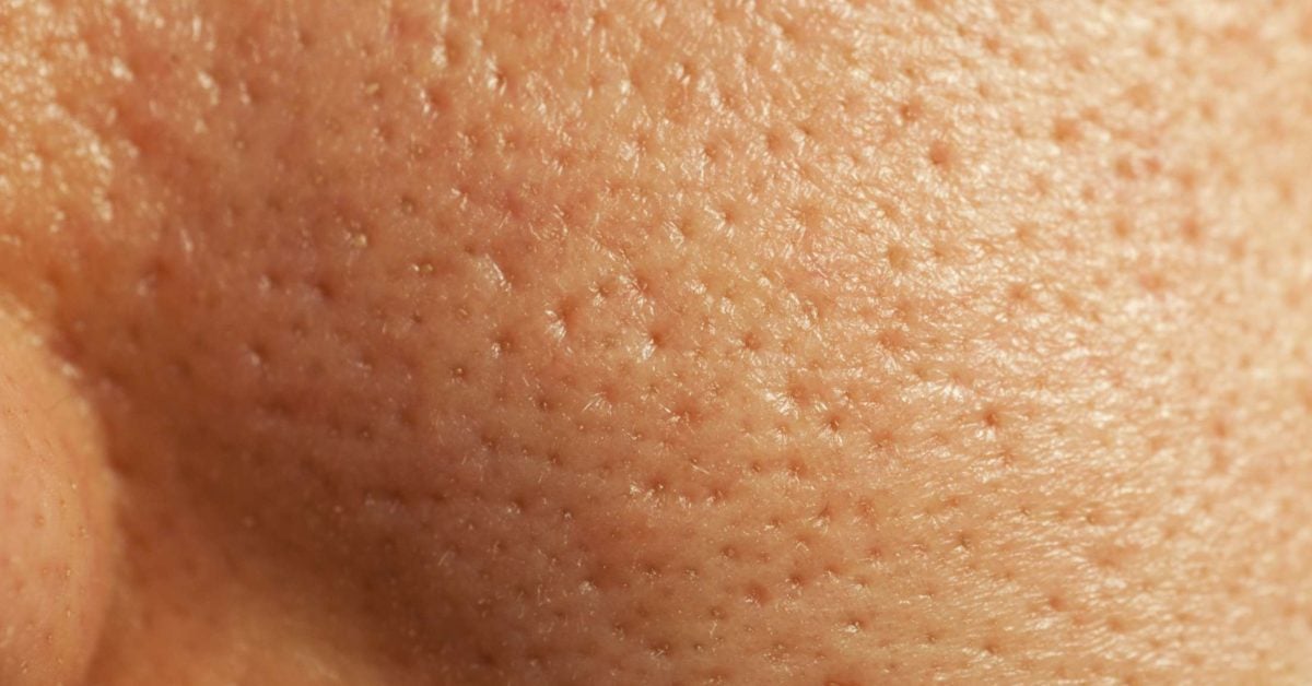 How to get rid of large pores: The top 8 ways