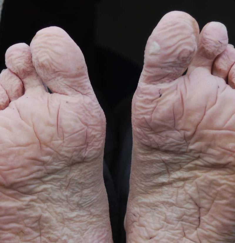 How Long Does It Take To Get Rid Of Trench Foot