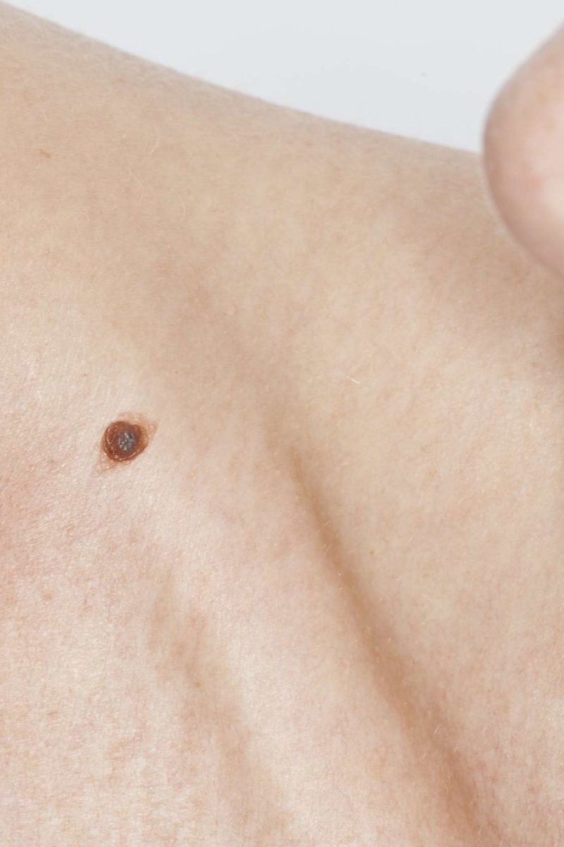 Itchy mole Causes, treatment, and symptoms