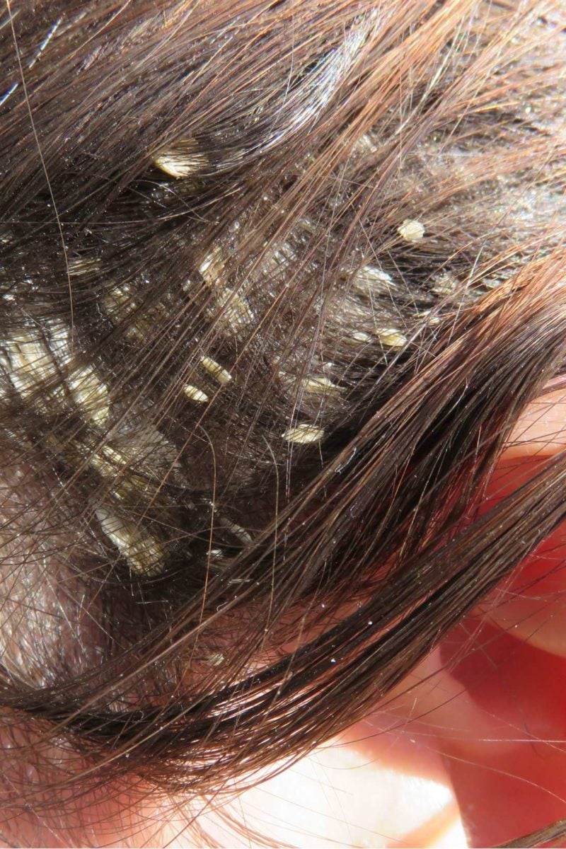 white scalp build up psoriasis dandruff scalp