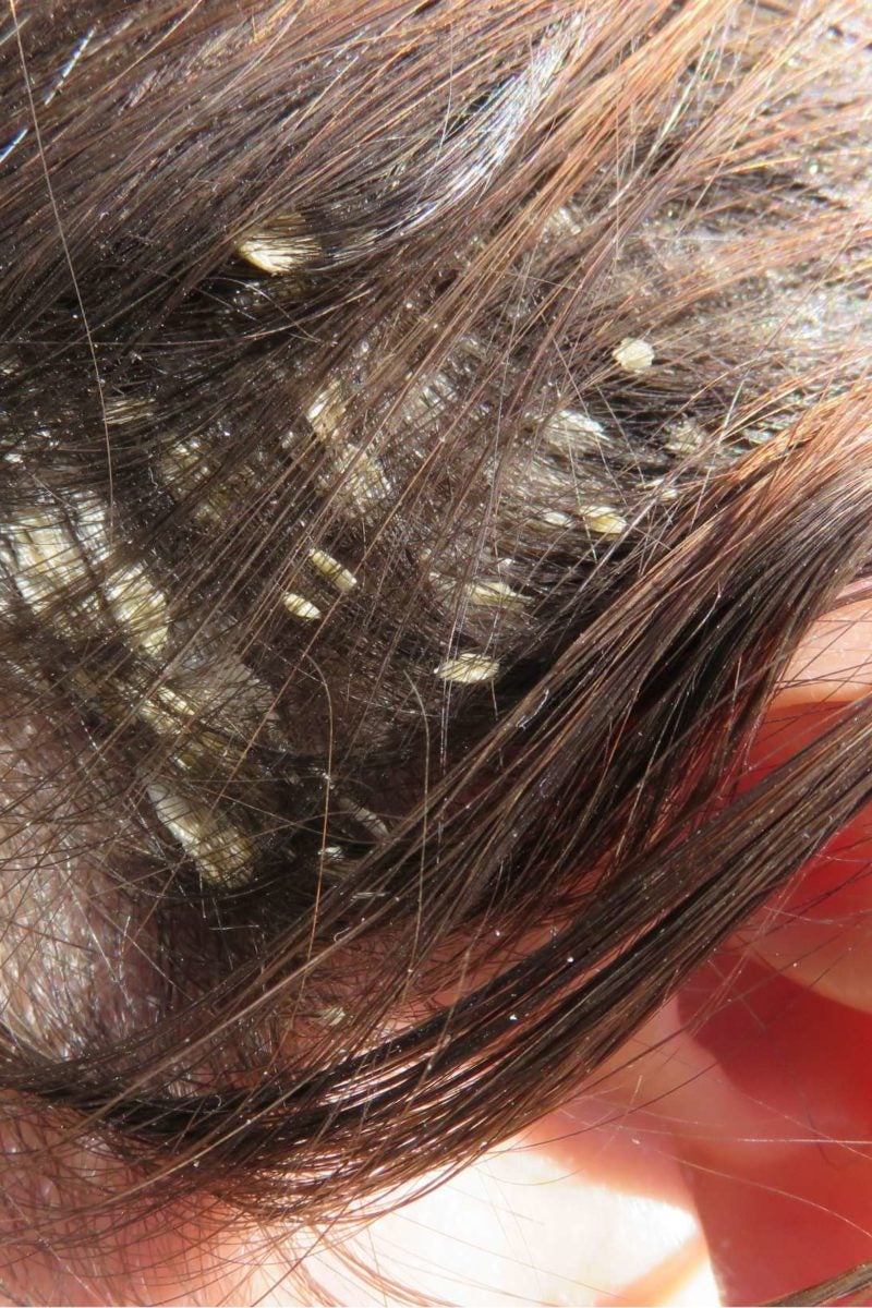 Scalp Eczema Symptoms Treatment And Remedies