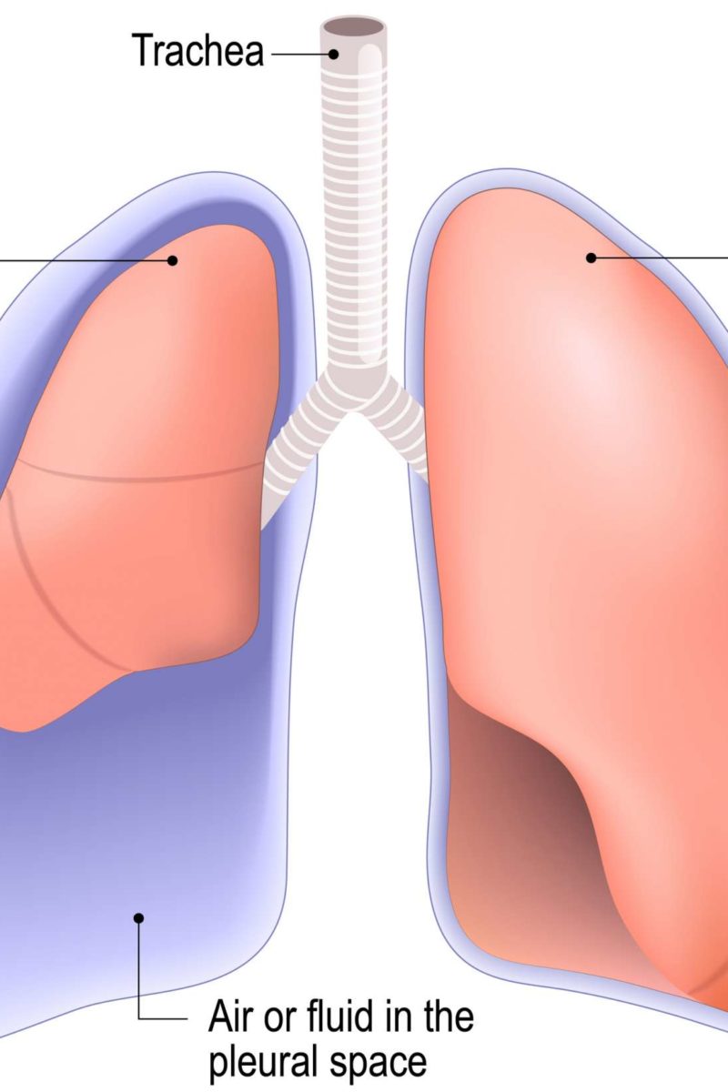 lung surgery for collapsed lung