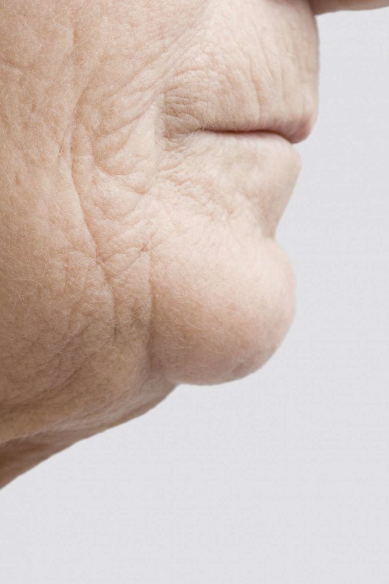 Jowls Exercises, causes, treatment, and prevention