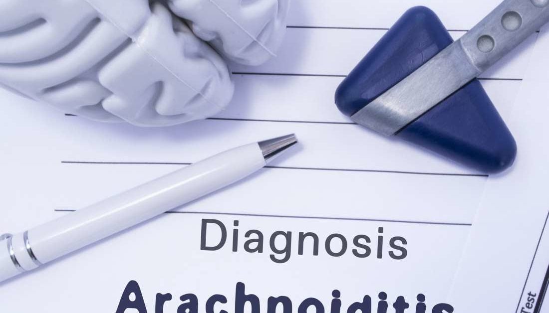 Arachnoiditis: Symptoms, types, causes, and treatment