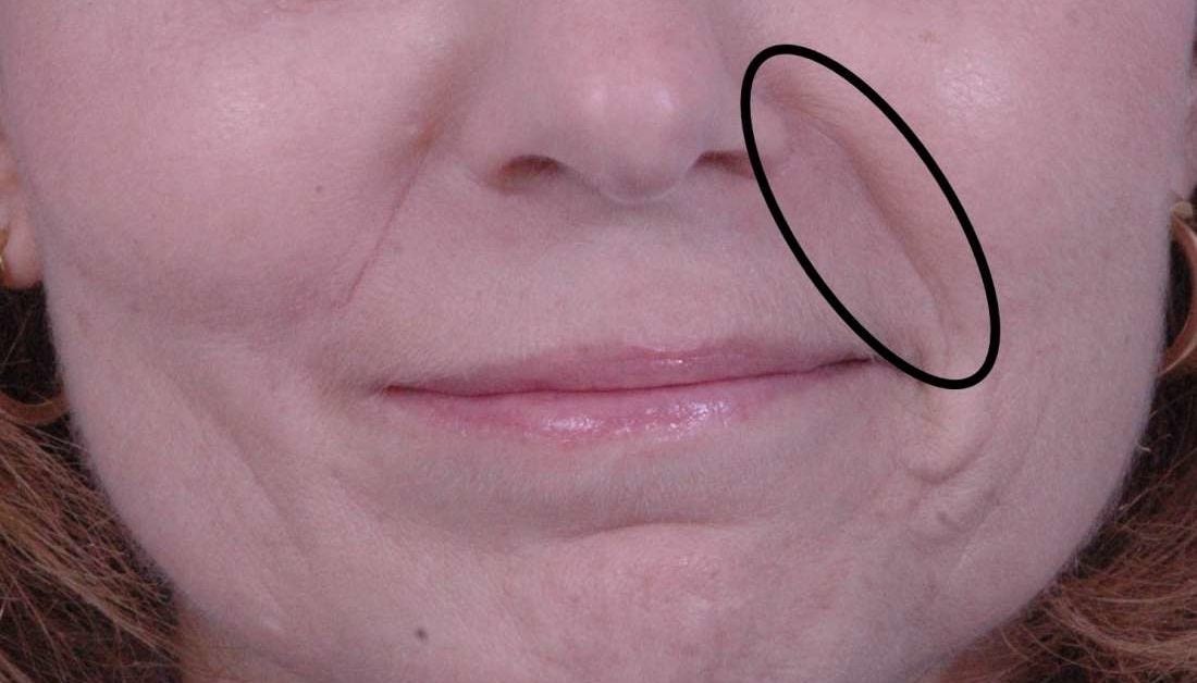 Nasolabial folds: Causes, treatment, exercises, and prevention