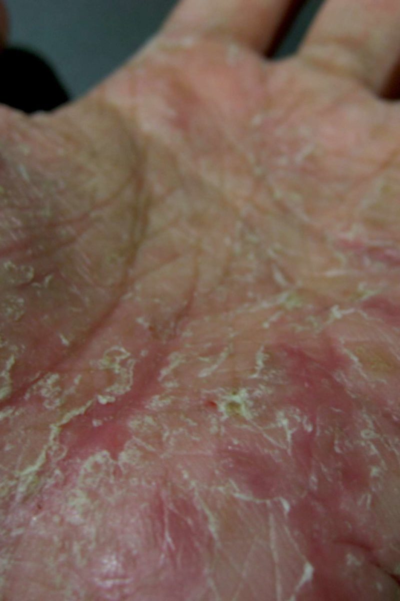 Stock fotó — Infection in hands - scabies. Eczema symptom