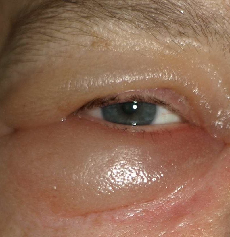 oedema under eye