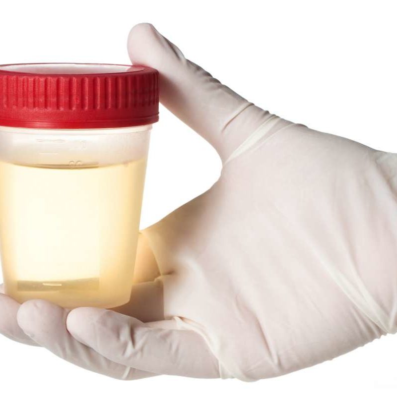 Urine Smells Like Ammonia Causes Treatments And Symptoms