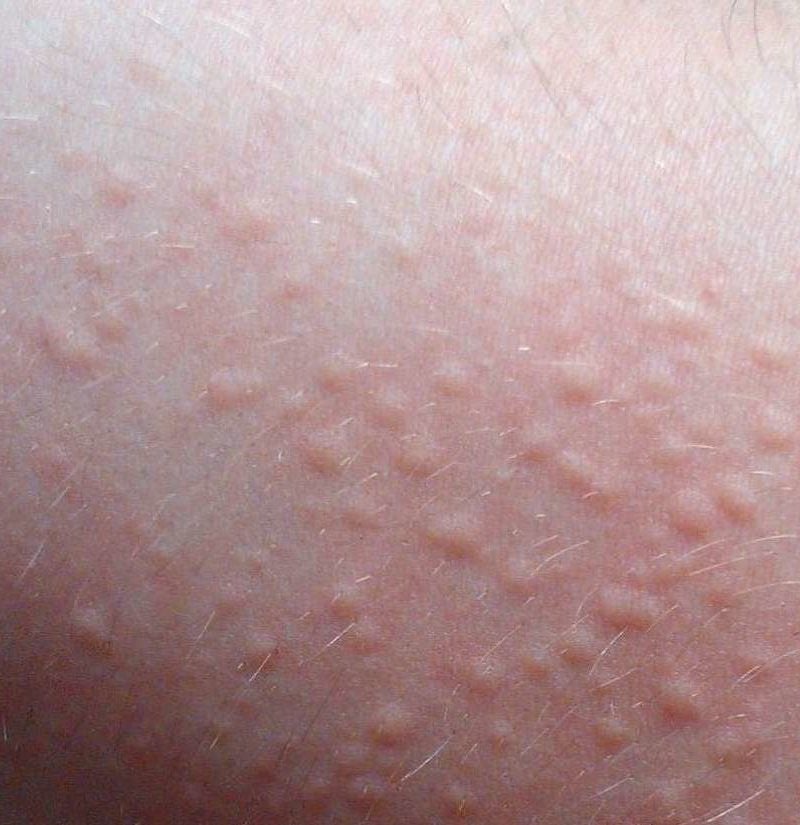 Skin Rash Types Causes Tests And More Sexiz Pix