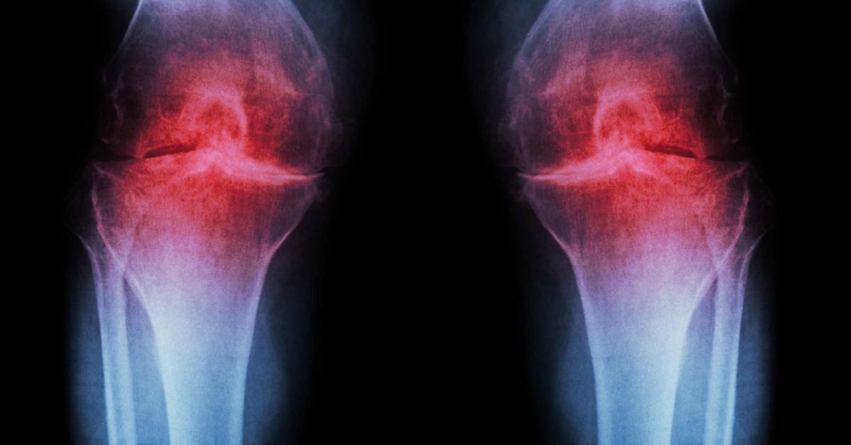 osteoarthritis-could-researchers-have-found-the-key-to-prevention