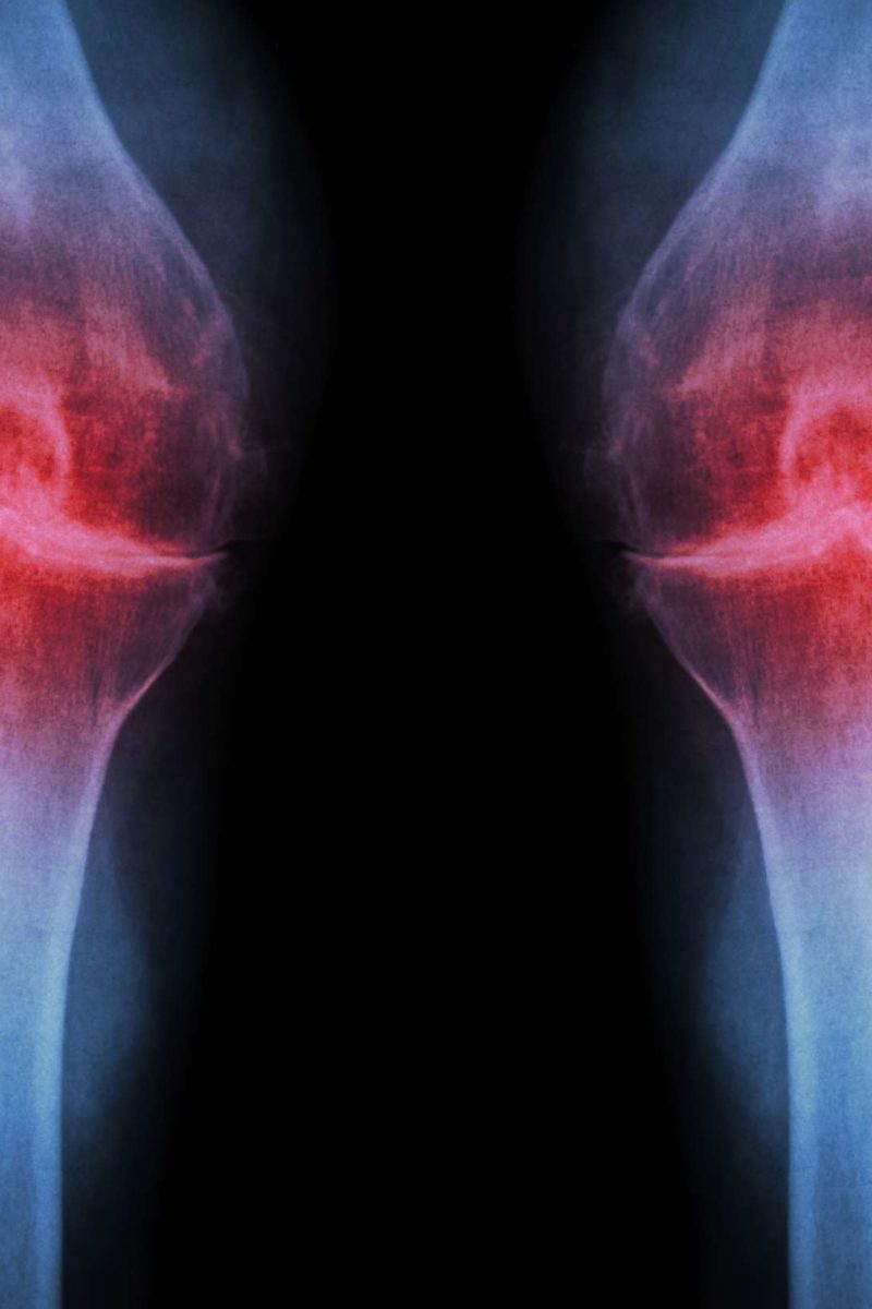 Osteoarthritis: Could researchers have found the key to prevention?