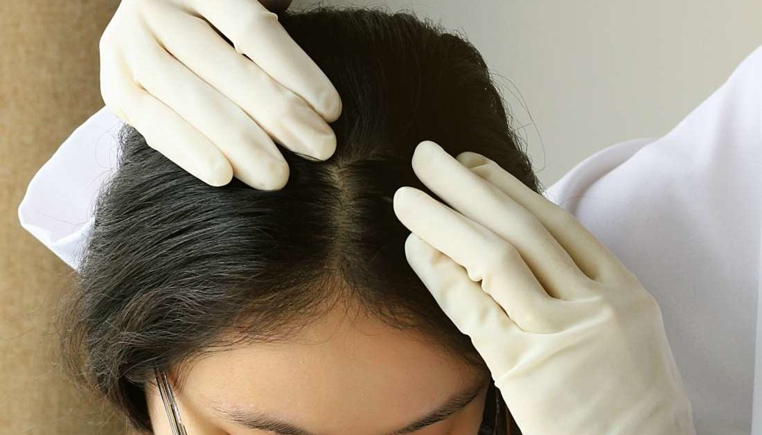 Scalp Acne Treatment Causes And Prevention