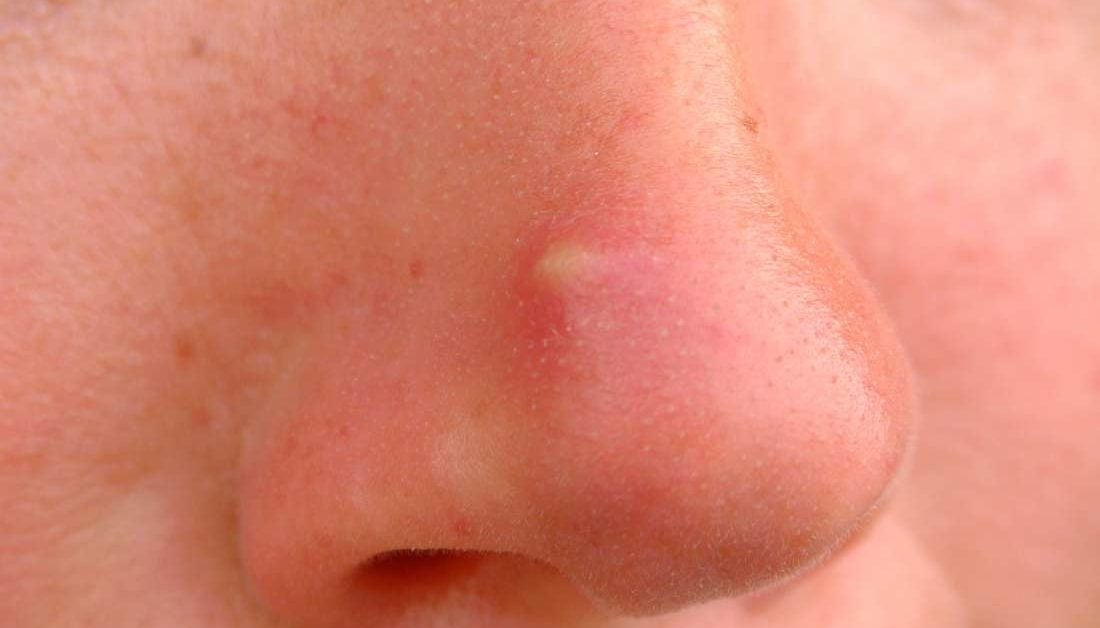 nose-acne-causes-treatment-and-remedies