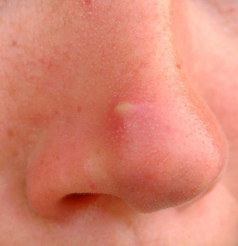 swollen pimple under skin