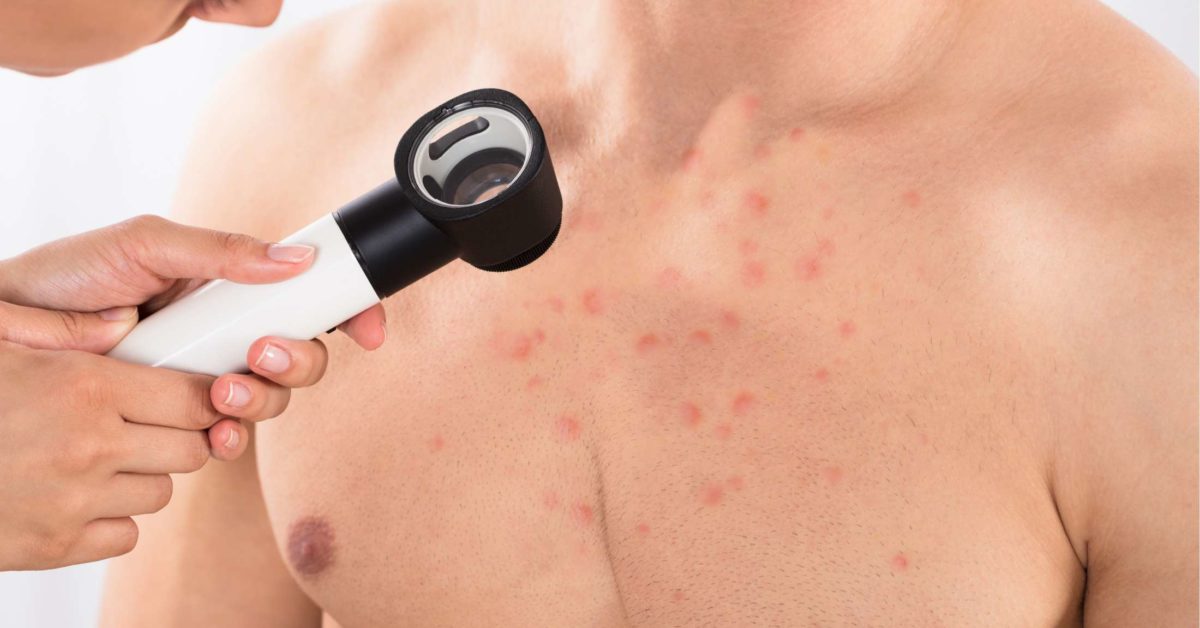 Chest Acne 8 Causes And How To Get Rid Of It