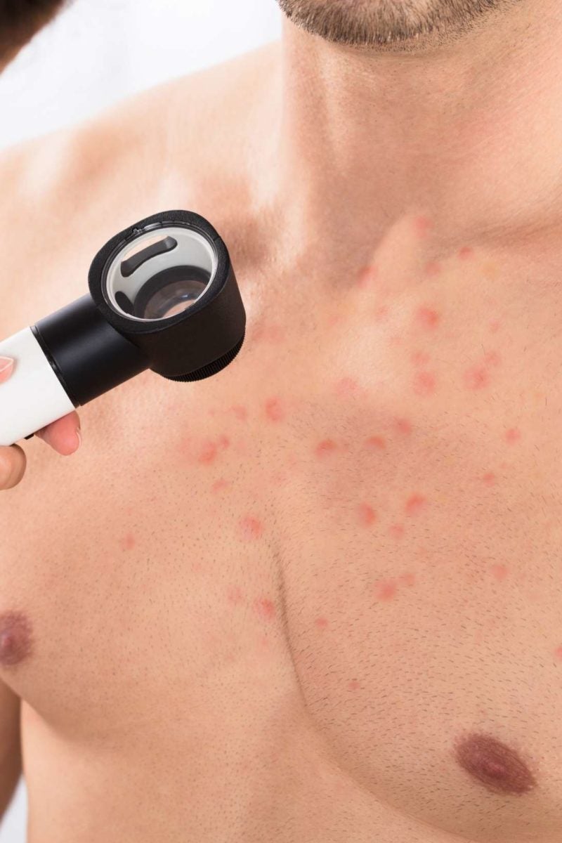 Chest acne: 8 causes and how to get rid of it